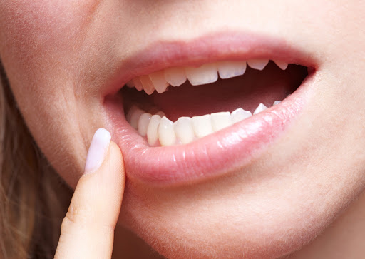 Что такое кандидоз полости рта